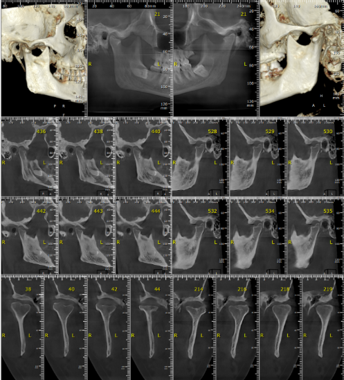 X-ray showing TMJ degeneration