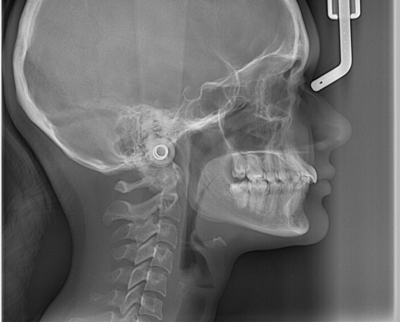 tmj-treatment-in-Hyderabad