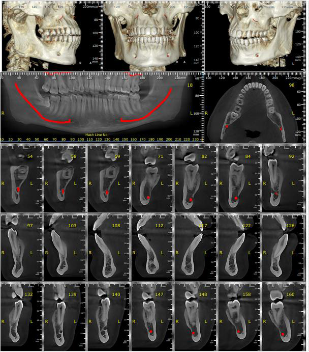 TMJ-Treatment-x-ray