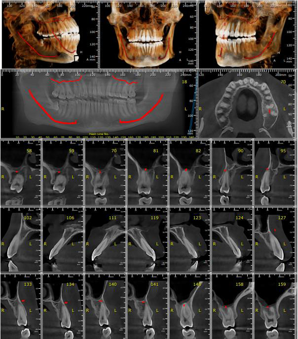 tmj-treatment-x-ray